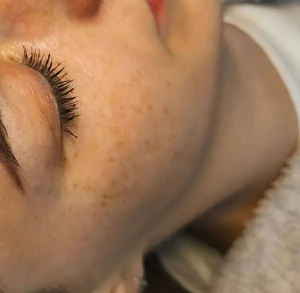 Hydratovaná žiarivá pleť po ošetrení Hydra Face Glow v Pezinku